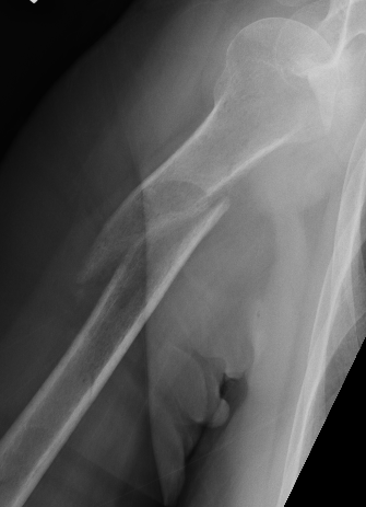 Humerus nonunion